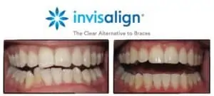 Invisalign before and after